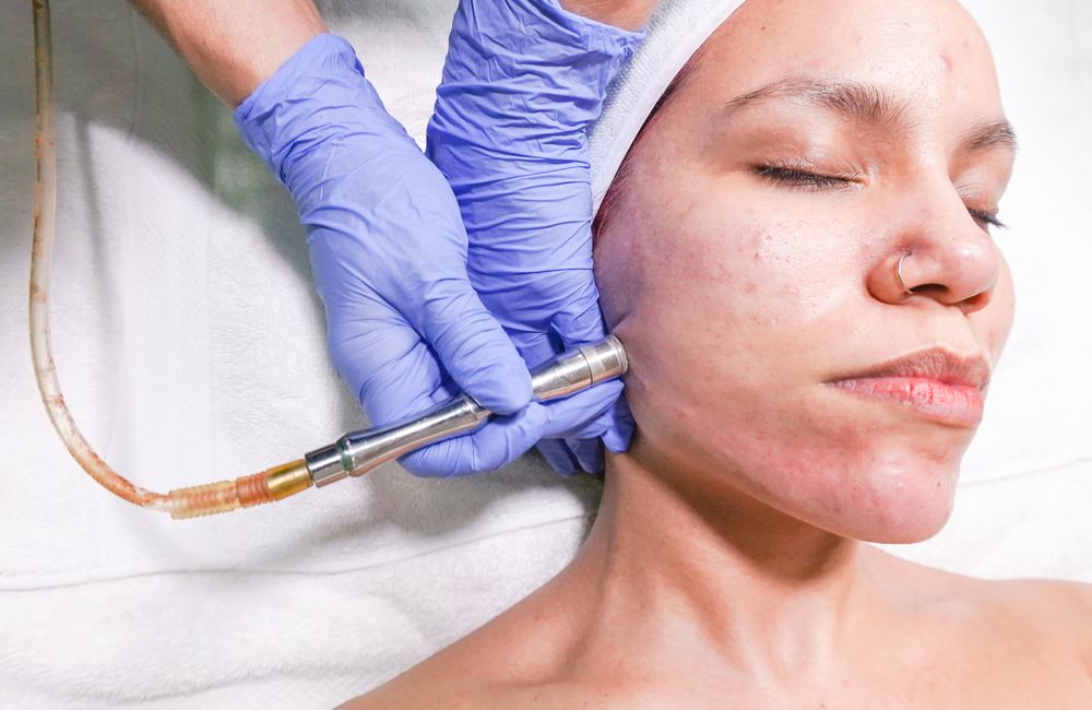Stock photograph: Professional microdermabrasion facial procedure; not Valeon staff, patients, or results
