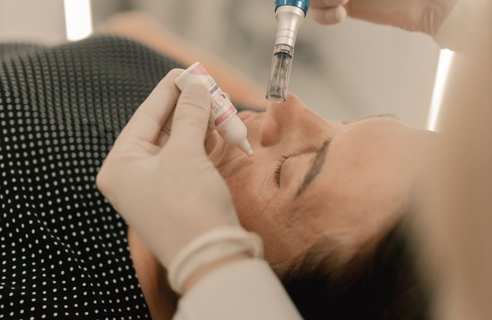 Stock photograph: Microneedling treatment with a clinical pen device; not Valeon staff, patients, or results